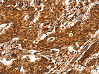 The image on the left is immunohistochemistry of paraffin-embedded Human gastric cancer tissue using CUEDC2 Antibody(CUEDC2 Antibody) at dilution 1/50, on the right is treated with fusion protein. (Original magnification: ×200)Rabbit anti-Human CUEDC2 Polyclonal Antibody