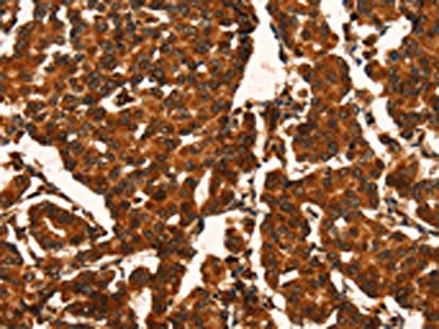 The image on the left is immunohistochemistry of paraffin-embedded Human breast cancer tissue using the antibody Antibody) at dilution 1/50, on the right is treated with fusion protein. (Original magnification: ×200)Rabbit anti-Human CUEDC2 Polyclonal Antibody