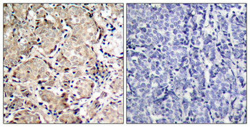 Immunohistochemical analysis of paraffin-embedded human breast carcinoma tissue using FKHR(Phospho-Ser319) Antibody(left) or the same antibody preincubated with blocking peptide(right).Rabbit anti-Human FOXO1 Polyclonal Antibody