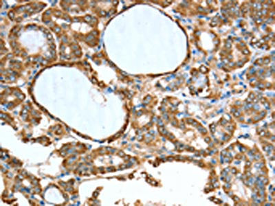 The image on the left is immunohistochemistry of paraffin-embedded Human thyroid cancer tissue using ALDH9A1 Antibody(ALDH9A1 Antibody) at dilution 1/50, on the right is treated with synthetic peptide. (Original magnification: ×200)Rabbit anti-Human ALDH9A1 Polyclonal Antibody