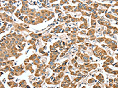 The image on the left is immunohistochemistry of paraffin-embedded Human breast cancer tissue using the antibody Antibody) at dilution 1/50, on the right is treated with synthetic peptide. (Original magnification: ×200)Rabbit anti-Human ALDH9A1 Polyclonal Antibody