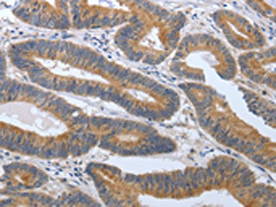 The image on the left is immunohistochemistry of paraffin-embedded Human colon cancer tissue using PGR Antibody(PGR Antibody) at dilution 1/30, on the right is treated with synthetic peptide. (Original magnification: ×200)Rabbit anti-Human PGR Polyclonal Antibody