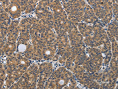 The image on the left is immunohistochemistry of paraffin-embedded Human thyroid cancer tissue using the antibody Antibody) at dilution 1/30, on the right is treated with synthetic peptide. (Original magnification: ×200)Rabbit anti-Human PGR Polyclonal Antibody