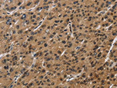 The image on the left is immunohistochemistry of paraffin-embedded Human liver cancer tissue using the antibody Antibody) at dilution 1/50, on the right is treated with synthetic peptide. (Original magnification: ×200)Rabbit anti-Human SYN1 Polyclonal Antibody