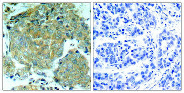 Immunohistochemical analysis of paraffin-embedded human breast carcinoma tissue using eIF2α (Phospho-Ser51) Antibody (left) or the same antibody preincubated with blocking peptide (right).Rabbit anti-Human EIF2S1 Polyclonal Antibody