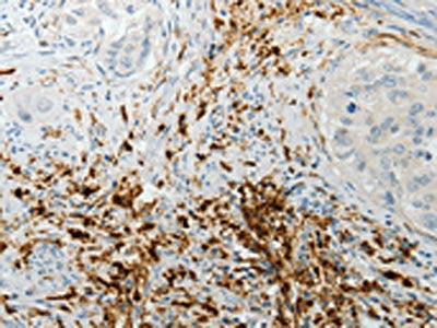 The image on the left is immunohistochemistry of paraffin-embedded Human lung cancer tissue using F13A1 Antibody(F13A1 Antibody) at dilution 1/15, on the right is treated with fusion protein. (Original magnification: X200)Rabbit anti-Human F13A1 Polyclonal Antibody