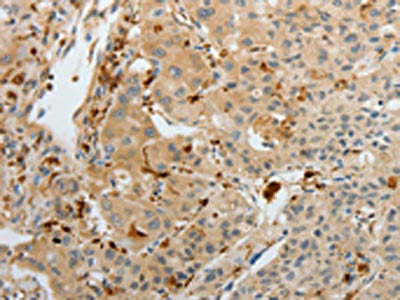 The image on the left is immunohistochemistry of paraffin-embedded Human cervical cancer tissue using the antibody Antibody) at dilution 1/15, on the right is treated with fusion protein. (Original magnification: X200)Rabbit anti-Human F13A1 Polyclonal Antibody