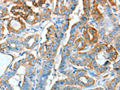 The image on the left is immunohistochemistry of paraffin-embedded Human thyroid cancer tissue using AGR3 Antibody(AGR3 Antibody) at dilution 1/15, on the right is treated with fusion protein. (Original magnification: ×200)