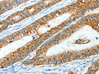 The image on the left is immunohistochemistry of paraffin-embedded Human colon cancer tissue using the antibody Antibody) at dilution 1/15, on the right is treated with fusion protein. (Original magnification: ×200)