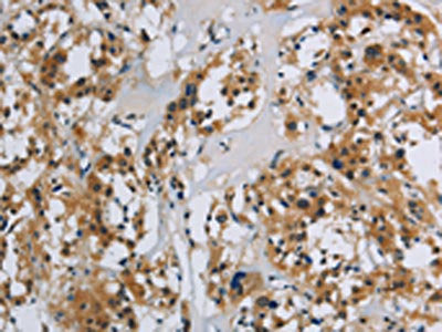 The image on the left is immunohistochemistry of paraffin-embedded Human thyroid cancer tissue using SYN1 Antibody(SYN1 Antibody) at dilution 1/40, on the right is treated with synthetic peptide. (Original magnification: ×200)Rabbit anti-Human SYN1 Polyclonal Antibody