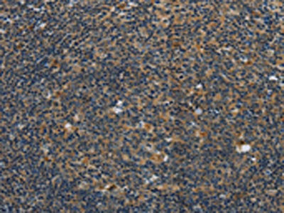 The image on the left is immunohistochemistry of paraffin-embedded Human tonsil tissue using the antibody Antibody) at dilution 1/40, on the right is treated with synthetic peptide. (Original magnification: ×200)Rabbit anti-Human SYN1 Polyclonal Antibody