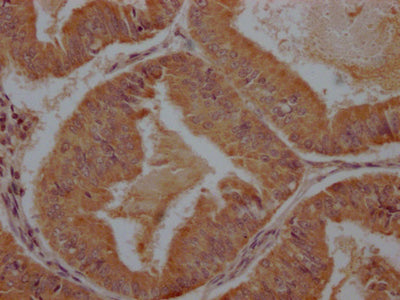 IHC image of the antibody diluted at 1:100 and staining in paraffin-embedded human endometrial cancer performed on a Leica BondTM system. After dewaxing and hydration, antigen retrieval was mediated by high pressure in a citrate buffer (pH 6.0). Section was blocked with 10% normal goat serum 30min at RT. Then primary antibody (1% BSA) was incubated at 4°C overnight. The primary is detected by a Goat anti-rabbit polymer IgG labeled by HRP and visualized using 0.05% DAB.Rabbit anti-Human PCDHB7 Polyclonal Antibody