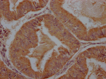 IHC image of the antibody diluted at 1:100 and staining in paraffin-embedded human endometrial cancer performed on a Leica BondTM system. After dewaxing and hydration, antigen retrieval was mediated by high pressure in a citrate buffer (pH 6.0). Section was blocked with 10% normal goat serum 30min at RT. Then primary antibody (1% BSA) was incubated at 4°C overnight. The primary is detected by a Goat anti-rabbit polymer IgG labeled by HRP and visualized using 0.05% DAB.Rabbit anti-Human PCDHB7 Polyclonal Antibody