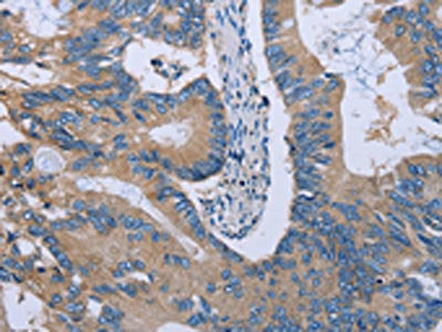 The image on the left is immunohistochemistry of paraffin-embedded Human colon cancer tissue using HYAL3 Antibody(HYAL3 Antibody) at dilution 1/40, on the right is treated with fusion protein. (Original magnification: ×200)Rabbit anti-Human HYAL3 Polyclonal Antibody