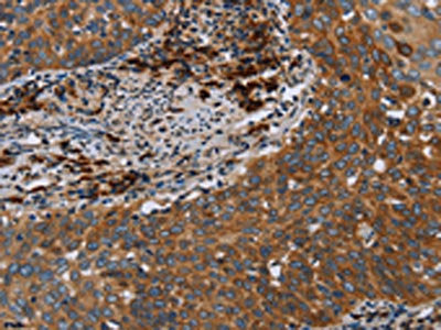 The image on the left is immunohistochemistry of paraffin-embedded Human cervical cancer tissue using the antibody Antibody) at dilution 1/40, on the right is treated with fusion protein. (Original magnification: ×200)Rabbit anti-Human HYAL3 Polyclonal Antibody