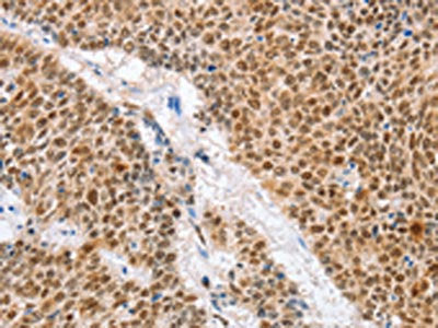 The image on the left is immunohistochemistry of paraffin-embedded Human lung cancer tissue using IRF6 Antibody(IRF6 Antibody) at dilution 1/50, on the right is treated with fusion protein. (Original magnification: ×200)