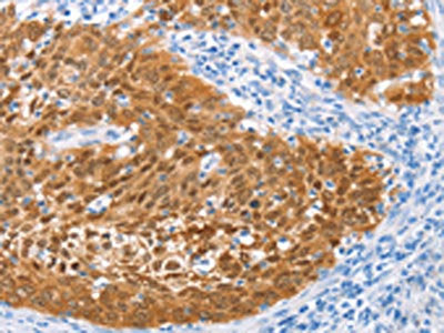 The image on the left is immunohistochemistry of paraffin-embedded Human cervical cancer tissue using the antibody Antibody) at dilution 1/50, on the right is treated with fusion protein. (Original magnification: ×200)