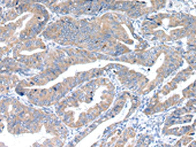 The image on the left is immunohistochemistry of paraffin-embedded Human esophagus cancer tissue using RAB2A Antibody(RAB2A Antibody) at dilution 1/40, on the right is treated with synthetic peptide. (Original magnification: ×200)Rabbit anti-Human RAB2A Polyclonal Antibody