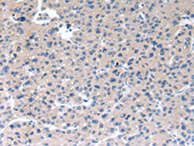 The image on the left is immunohistochemistry of paraffin-embedded Human liver cancer tissue using the antibody Antibody) at dilution 1/40, on the right is treated with synthetic peptide. (Original magnification: ×200)Rabbit anti-Human RAB2A Polyclonal Antibody