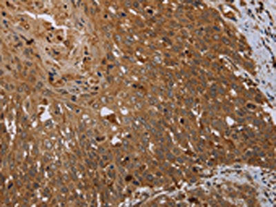 The image on the left is immunohistochemistry of paraffin-embedded Human cervical cancer tissue using HSD17B4 Antibody(HSD17B4 Antibody) at dilution 1/20, on the right is treated with fusion protein. (Original magnification: ×200)Rabbit anti-Human HSD17B4 Polyclonal Antibody