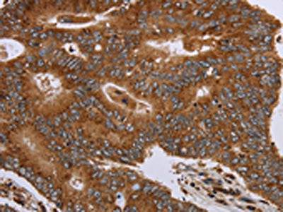 The image on the left is immunohistochemistry of paraffin-embedded Human colon cancer tissue using the antibody Antibody) at dilution 1/20, on the right is treated with fusion protein. (Original magnification: ×200)Rabbit anti-Human HSD17B4 Polyclonal Antibody