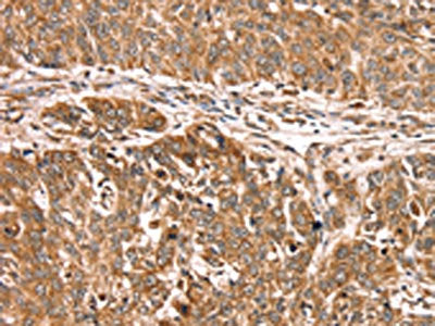 The image on the left is immunohistochemistry of paraffin-embedded Human lung cancer tissue using PDLIM4 Antibody(PDLIM4 Antibody) at dilution 1/30, on the right is treated with fusion protein. (Original magnification: ×200)Rabbit anti-Human PDLIM4 Polyclonal Antibody