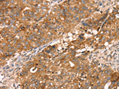 The image on the left is immunohistochemistry of paraffin-embedded Human breast cancer tissue using the antibody Antibody) at dilution 1/30, on the right is treated with fusion protein. (Original magnification: ×200)Rabbit anti-Human PDLIM4 Polyclonal Antibody