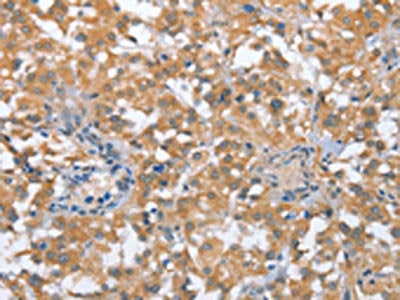 The image on the left is immunohistochemistry of paraffin-embedded Human thyroid cancer tissue using the antibody Antibody) at dilution 1/35, on the right is treated with fusion protein. (Original magnification: ×200)Rabbit anti-Human TP53BP2 Polyclonal Antibody
