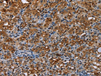 The image on the left is immunohistochemistry of paraffin-embedded Human thyroid cancer tissue using ME1 Antibody(ME1 Antibody) at dilution 1/20, on the right is treated with synthetic peptide. (Original magnification: ×200)