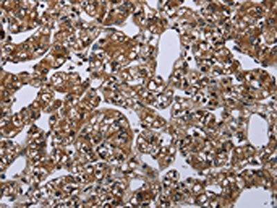 The image on the left is immunohistochemistry of paraffin-embedded Human prostate cancer tissue using the antibody Antibody) at dilution 1/20, on the right is treated with synthetic peptide. (Original magnification: ×200)