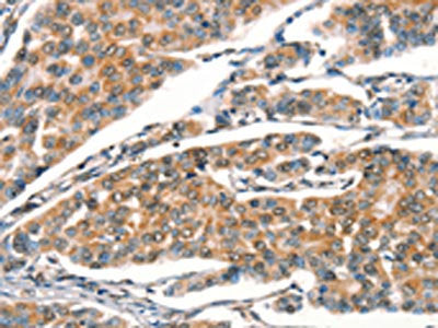 The image on the left is immunohistochemistry of paraffin-embedded Human breast cancer tissue using STK17A Antibody(STK17A  Antibody) at dilution 1/25, on the right is treated with synthetic peptide. (Original magnification: ×200)Rabbit anti-Human STK17A Polyclonal Antibody