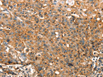 The image on the left is immunohistochemistry of paraffin-embedded Human gastic cancer tissue using the antibody  Antibody) at dilution 1/25, on the right is treated with synthetic peptide. (Original magnification: ×200)Rabbit anti-Human STK17A Polyclonal Antibody