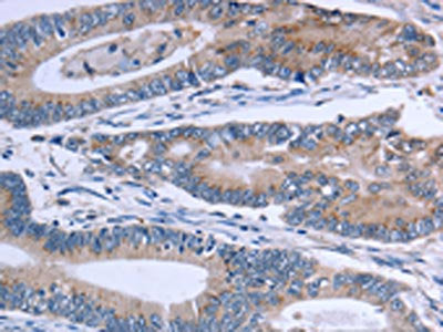 The image on the left is immunohistochemistry of paraffin-embedded Human colon cancer tissue using SLC1A6 Antibody(SLC1A6 Antibody) at dilution 1/40, on the right is treated with synthetic peptide. (Original magnification: ×200)Rabbit anti-Human SLC1A6 Polyclonal Antibody