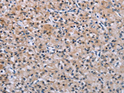 The image on the left is immunohistochemistry of paraffin-embedded Human prostate cancer tissue using the antibody Antibody) at dilution 1/40, on the right is treated with synthetic peptide. (Original magnification: ×200)Rabbit anti-Human SLC1A6 Polyclonal Antibody
