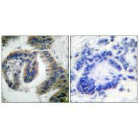 Immunohistochemical analysis of paraffin-embedded human lung carcinoma tissue using HSP40 antibody.Rabbit anti-Human DNAJB1 Polyclonal Antibody