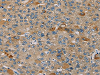 The image on the left is immunohistochemistry of paraffin-embedded Human liver cancer tissue using PEF1 Antibody(PEF1 Antibody) at dilution 1/20, on the right is treated with fusion protein. (Original magnification: ×200)Rabbit anti-Human PEF1 Polyclonal Antibody