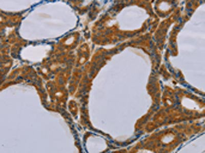 The image on the left is immunohistochemistry of paraffin-embedded Human thyroid cancer tissue using the antibody Antibody) at dilution 1/20, on the right is treated with fusion protein. (Original magnification: ×200)Rabbit anti-Human PEF1 Polyclonal Antibody