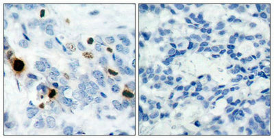 Immunohistochemical analysis of paraffin-embedded human breast carcinoma tissue using Histone H3.1(Phospho-Ser10) Antibody(left) or the same antibody preincubated with blocking peptide(right).Rabbit anti-Human HIST1H3A Polyclonal Antibody