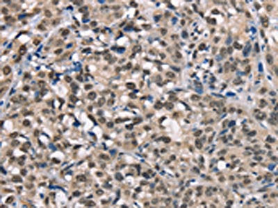 The image on the left is immunohistochemistry of paraffin-embedded Human esophagus cancer tissue using NDNL2 Antibody(NDNL2 Antibody) at dilution 1/40, on the right is treated with synthetic peptide. (Original magnification: ×200)Rabbit anti-Human NDNL2 Polyclonal Antibody