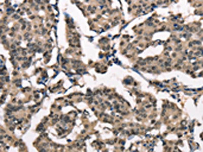 The image on the left is immunohistochemistry of paraffin-embedded Human breast cancer tissue using the antibody Antibody) at dilution 1/40, on the right is treated with synthetic peptide. (Original magnification: ×200)Rabbit anti-Human NDNL2 Polyclonal Antibody
