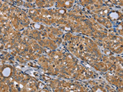 The image on the left is immunohistochemistry of paraffin-embedded Human thyroid cancer tissue using TRIM29 Antibody(TRIM29 Antibody) at dilution 1/50, on the right is treated with fusion protein. (Original magnification: ×200)Rabbit anti-Human TRIM29 Polyclonal Antibody