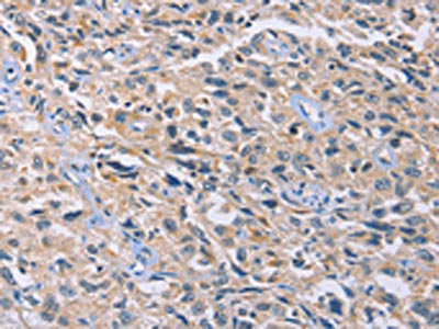 The image on the left is immunohistochemistry of paraffin-embedded Human esophagus cancer tissue using GNB5 Antibody(GNB5 Antibody) at dilution 1/20, on the right is treated with fusion protein. (Original magnification: ×200)Rabbit anti-Human GNB5 Polyclonal Antibody