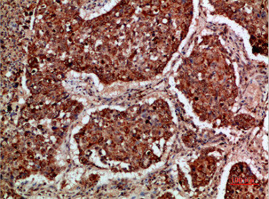 Immunohistochemical analysis of paraffin-embedded human-lung-cancer, antibody was diluted at 1:200Rabbit anti-Human IMP3 Polyclonal Antibody