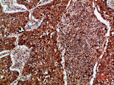 Immunohistochemical analysis of paraffin-embedded human-lung-cancer, antibody was diluted at 1:200Rabbit anti-Human IMP3 Polyclonal Antibody