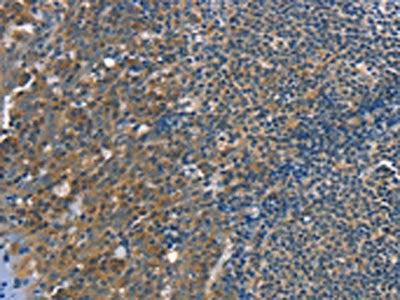 The image on the left is immunohistochemistry of paraffin-embedded Human tonsil tissue using TRIM31 Antibody(TRIM31 Antibody) at dilution 1/20, on the right is treated with fusion protein. (Original magnification: ×200)Rabbit anti-Human TRIM31 Polyclonal Antibody