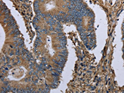 The image on the left is immunohistochemistry of paraffin-embedded Human colon cancer tissue using the antibody Antibody) at dilution 1/30, on the right is treated with fusion protein. (Original magnification: ×200)