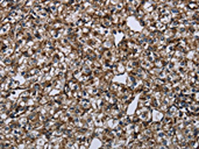 The image on the left is immunohistochemistry of paraffin-embedded Human prostate cancer tissue using the antibody Antibody) at dilution 1/30, on the right is treated with fusion protein. (Original magnification: ×200)