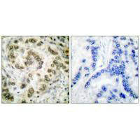 Immunohistochemical analysis of paraffin-embedded human lung carcinoma tissue using E2F4 antibody.Rabbit anti-Human E2F4 Polyclonal Antibody