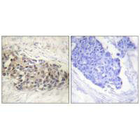 Immunohistochemistry analysis of paraffin-embedded human breast carcinoma tissue using USF2 antibody.Rabbit anti-Human USF2 Polyclonal Antibody