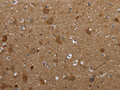 The image on the left is immunohistochemistry of paraffin-embedded Human brain tissue using the antibody Antibody) at dilution 1/30, on the right is treated with synthetic peptide. (Original magnification: ×200)Rabbit anti-Human PPP1R13L Polyclonal Antibody